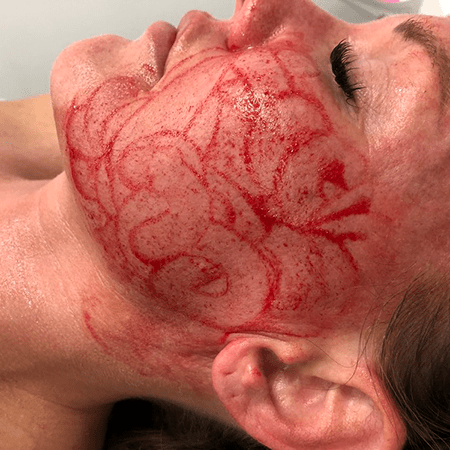 PLATELET RICH PLASMA & PLATELET RICH FIBRIN TREATMENTS