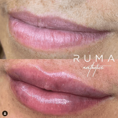 Lip fillers