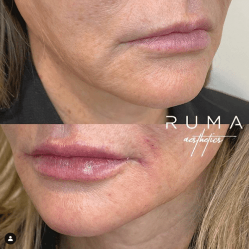 Lip fillers