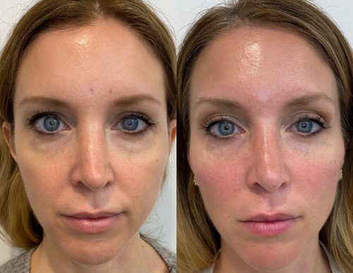Treatment Before and After