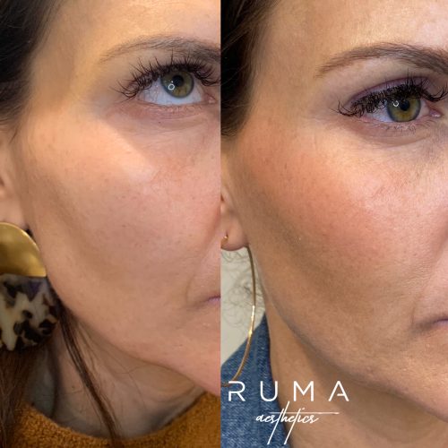 Sculptra