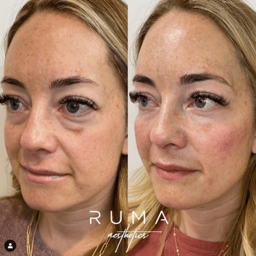 before and after Signature Tear Through and Cheeck Filler