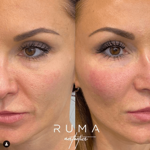 Signature Tear through & cheek filler
