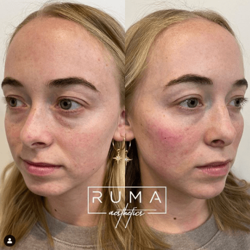 Signature Tear through & cheek filler