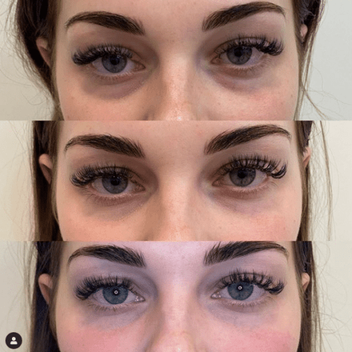 Signature Tear through & cheek filler