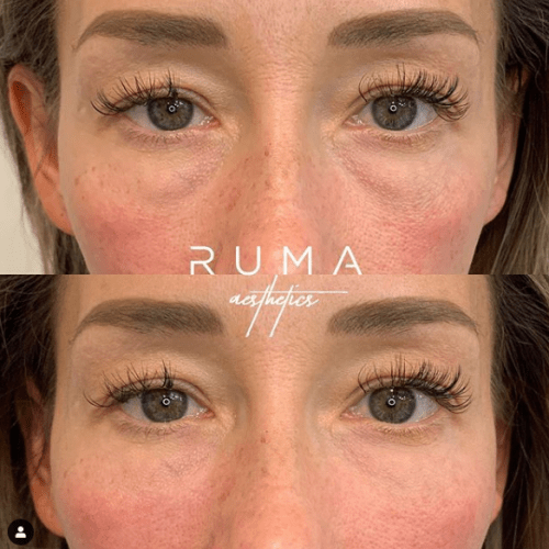 Before and After Images Signature Tear Through and Cheeck Filler