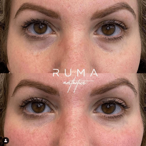 Before and After Images Signature Tear Through and Cheeck Filler
