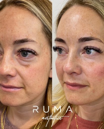 Filler Treatment Before and after