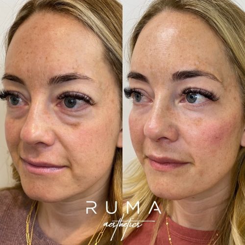 Filler Treatment Before and after