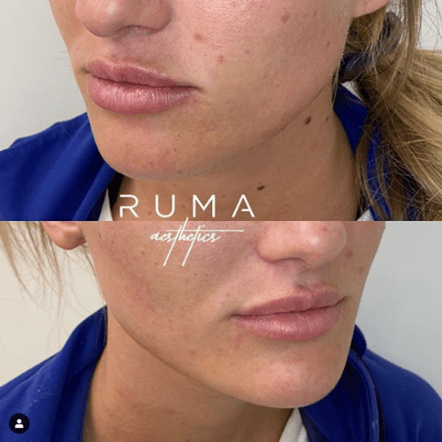 chin& jaive before and after