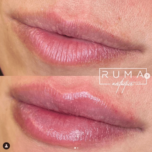 lip filler