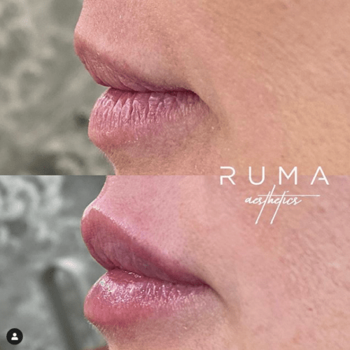 lip filler Before and After Images