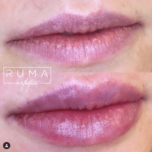lip filler