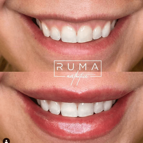 lip filler