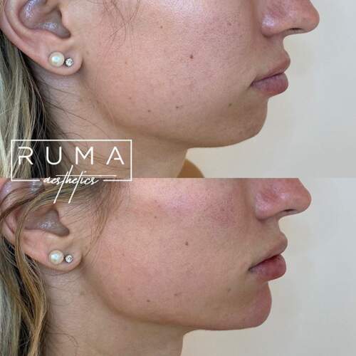Chin Augmentation
