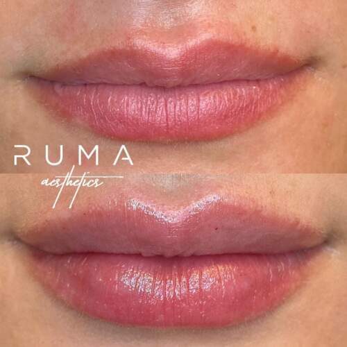 Lip filler