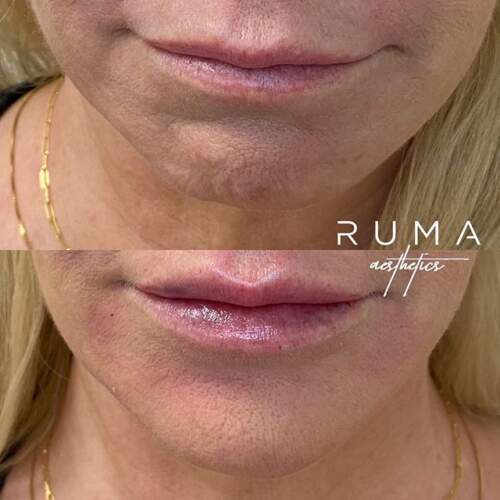Lip filler