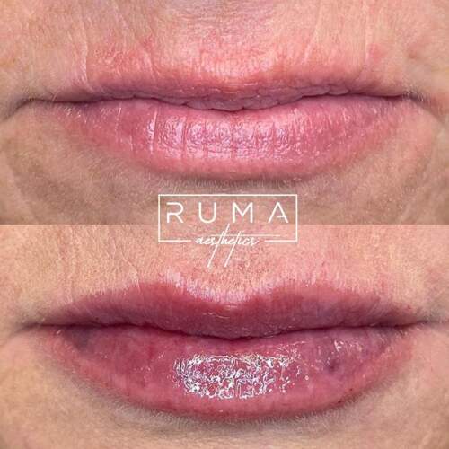 Lip filler