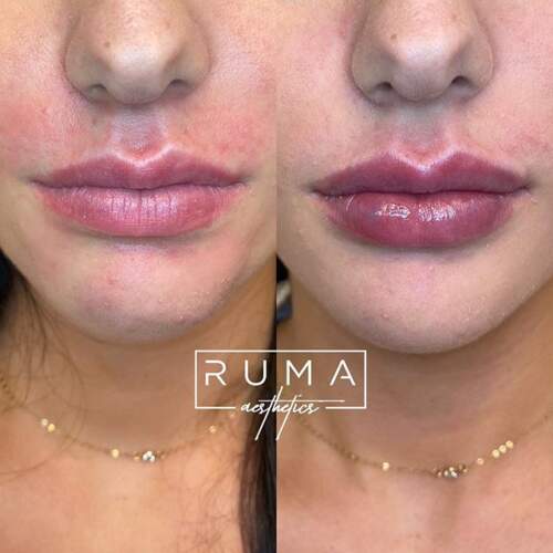 Lip filler
