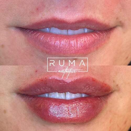 Lip filler