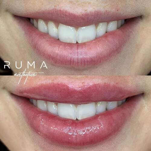 Lip filler