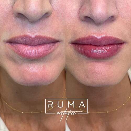Lip filler
