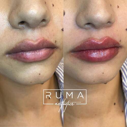 Lip filler