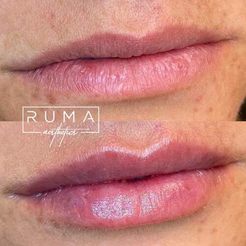 Lip filler