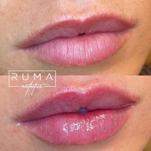 Lip filler